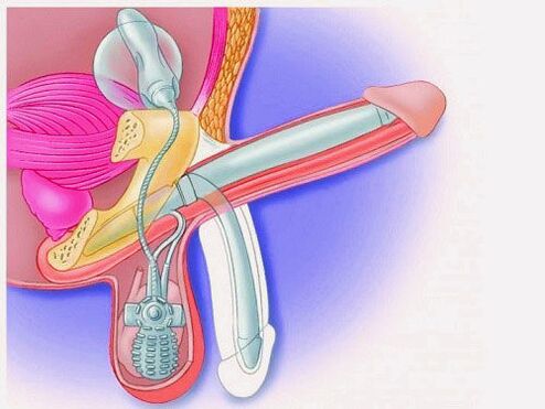 Pagpadako sa penis pinaagi sa penile prosthesis