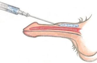 Usa ka makuyaw nga paagi sa pagpadako sa kinatawo gamit ang Vaseline injection